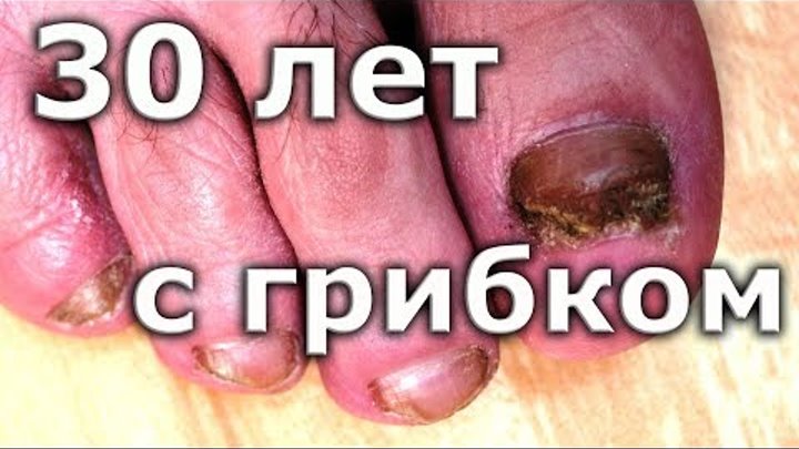 ВЫЛЕЧИЛ грибок ногтей спустя 30 лет, Лечение грибка ногтей