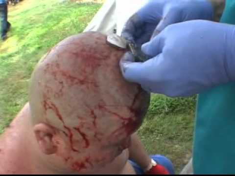 Abdullah The Kobayashi Gets a metal bed of Nails stuck in his head at TOD