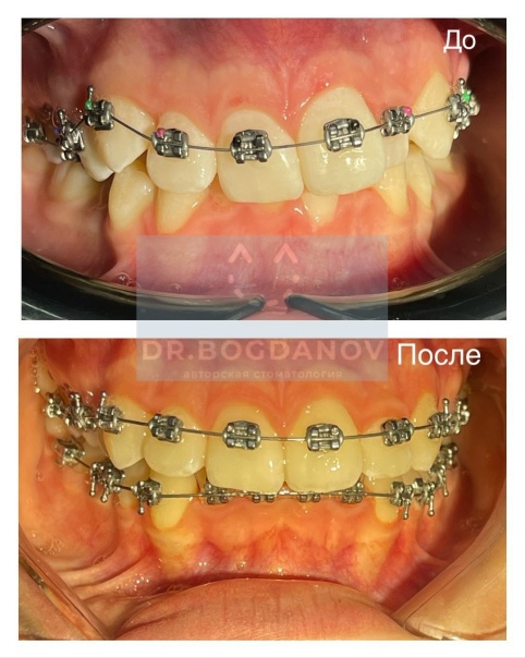 Брекеты проект 10 класс
